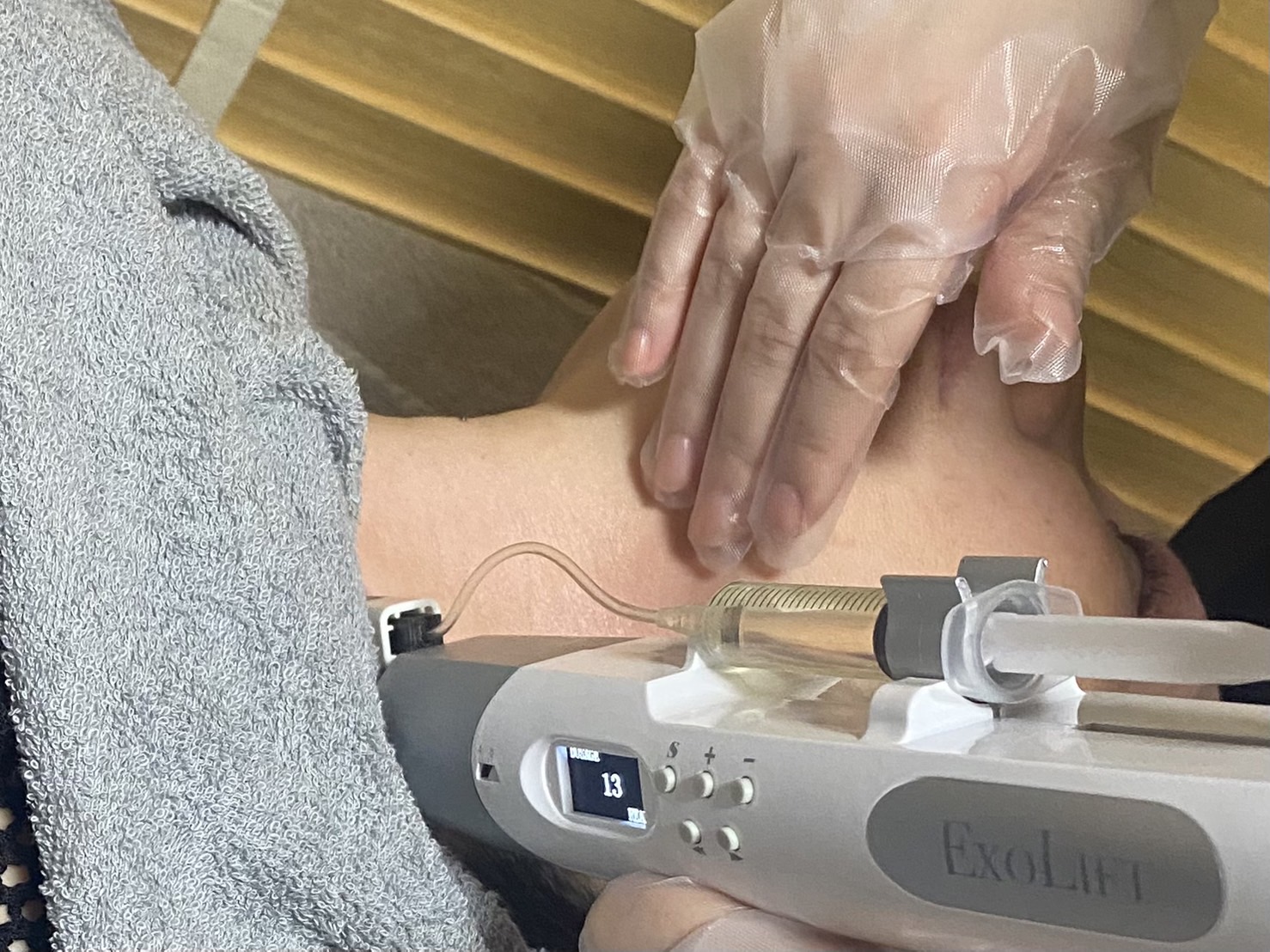 エクソリフト施術